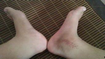 脚骨折吃哈密瓜好吗,骨折期间食用哈密瓜的适宜性探讨